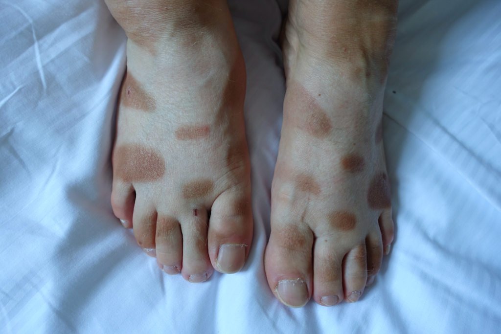 „Leopardenfüße“ bekommt man, wenn man mit Sandalen ohne Socken fährt ;)